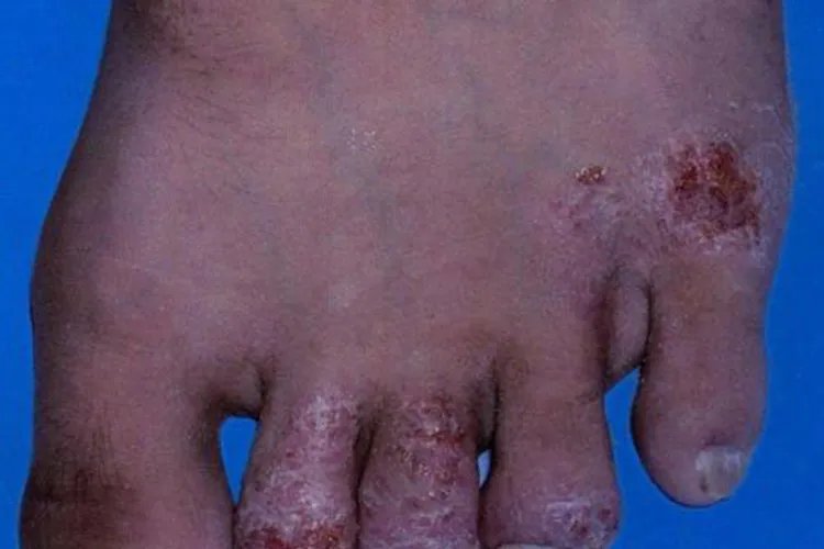 脚上皮肤病图片