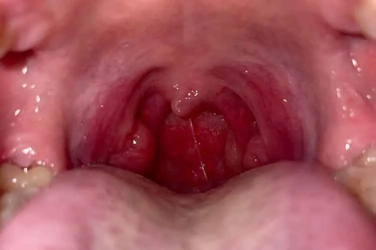 扁桃体和咽喉炎区分图