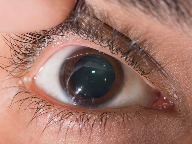 常见眼病有哪些