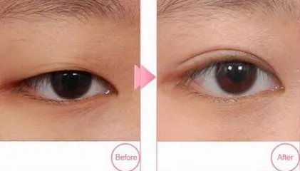 开眼角整形要多少钱