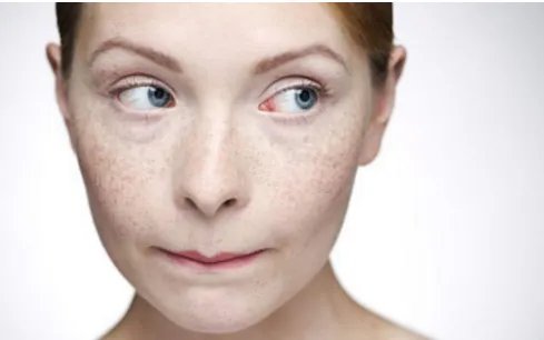 脸上晒的斑怎么去掉