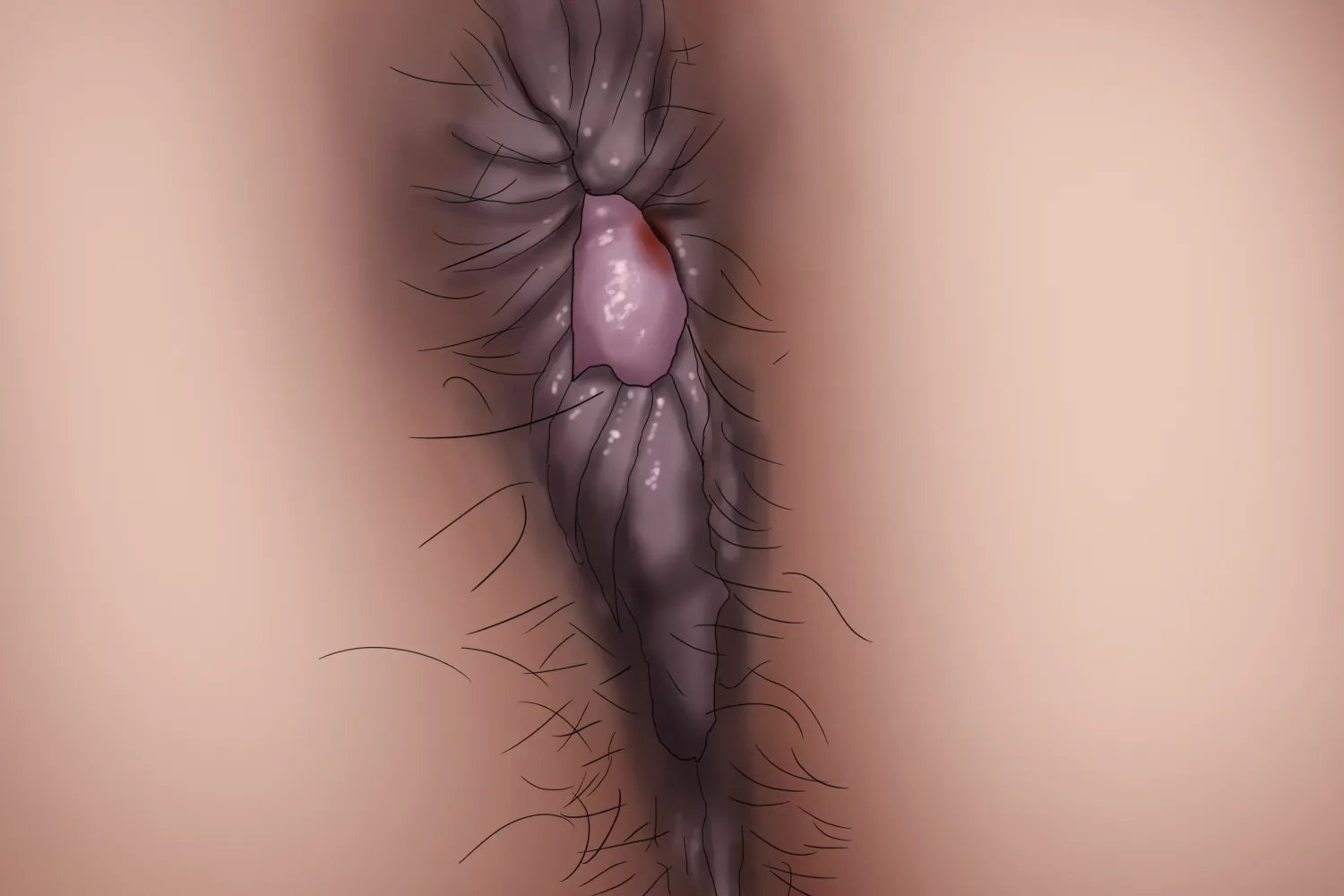 女性外痔初期图片大全