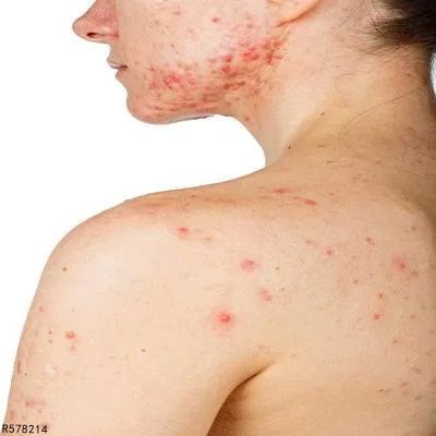 聚合性痤疮应该如何预防 介绍聚合性痤疮的几个预防方法