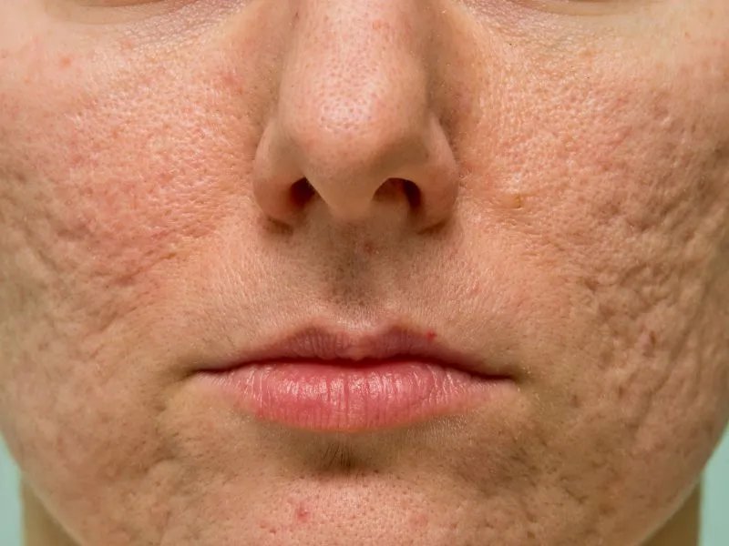 鼻子上毛孔大怎么办