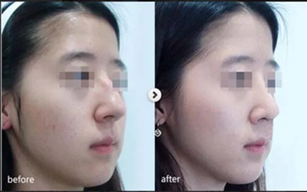 成都隆鼻哪家医院好