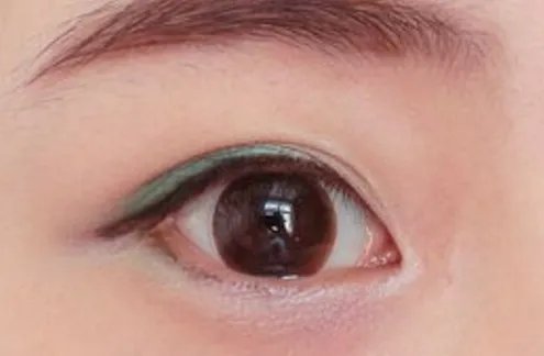 开眼角整形要多少钱