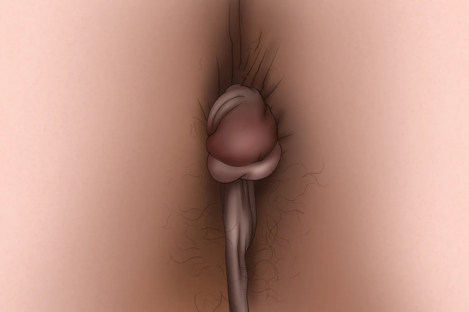 女性外痔初期图片大全