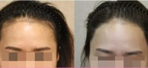 种植发际线大概要多少钱		