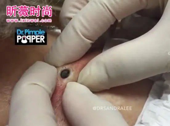 3年黑头被拔出 过程太吓人（图）