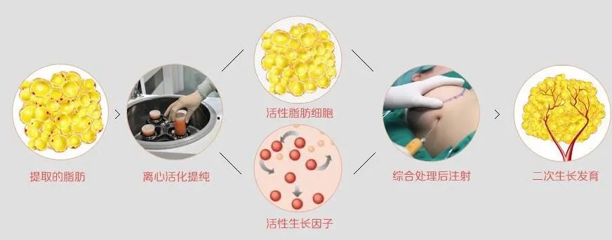 自体脂肪隆胸手术是如何操作的？