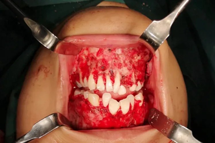 巨颌症牙龈症状图片