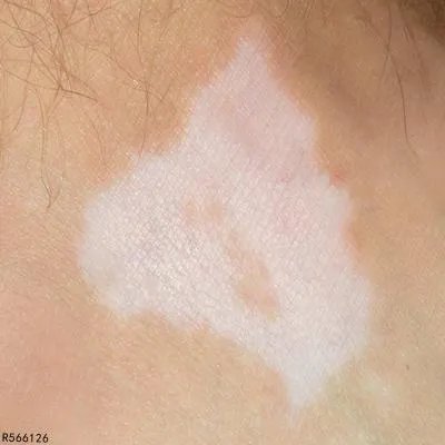 白癜风是怎么引起的