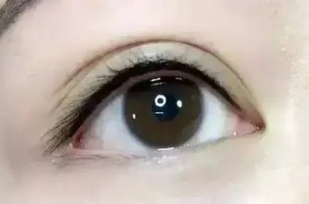 内双的人割双眼皮