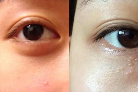 北京做双眼皮哪家医院好？