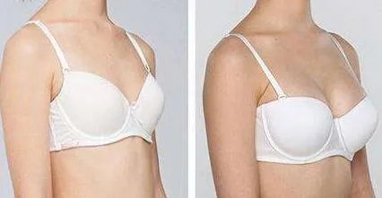 脂肪隆胸价格