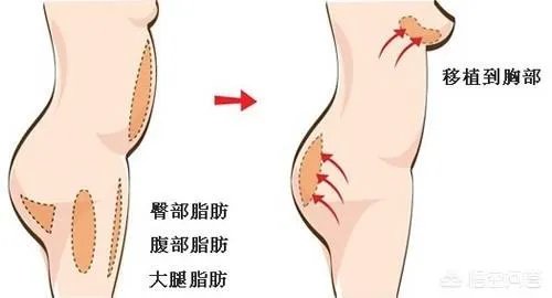 隆胸的填充物是什么?对身体有什么伤害?