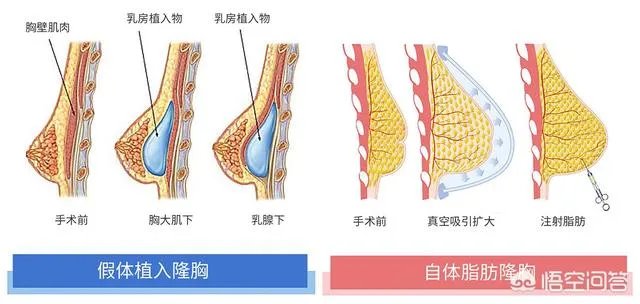 隆胸的填充物是什么？对身体有什么伤害？