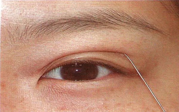 重庆韩式三点双眼皮去哪家医院好