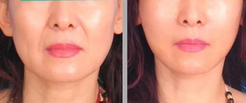 玻尿酸鼻唇沟填充价格多少钱