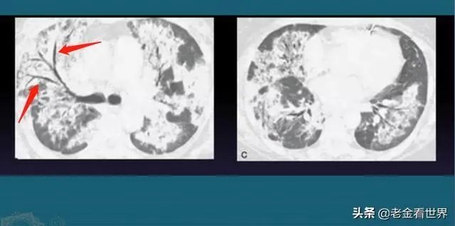 值得警惕：美国的新冠病毒究竟隐瞒了多久？