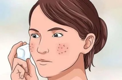 做祛痘需要多少钱？费用是多少？