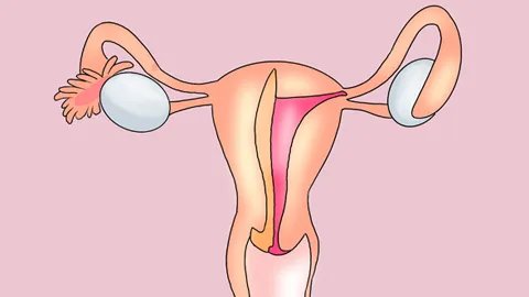 中度宫颈糜烂有哪些症状