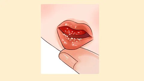 长期口角糜烂应该怎样治疗