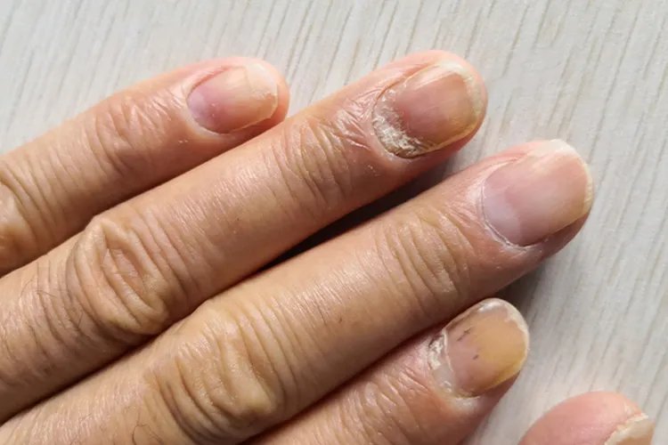 灰指甲图片治疗方法