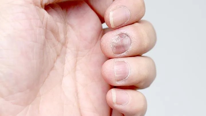 灰指甲的治疗偏方是什么