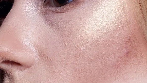 皮肤晒伤怎么办