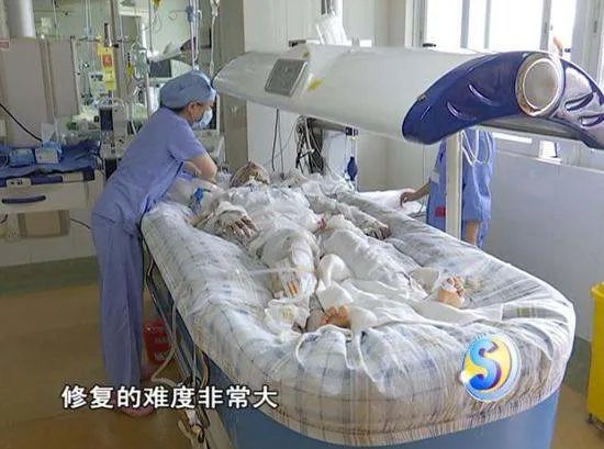 少女洗澡煤气爆炸现在什么情况?