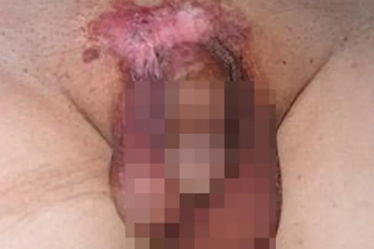 阴囊Paget病症状图片