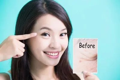 脸部痤疮的治疗方法有哪些