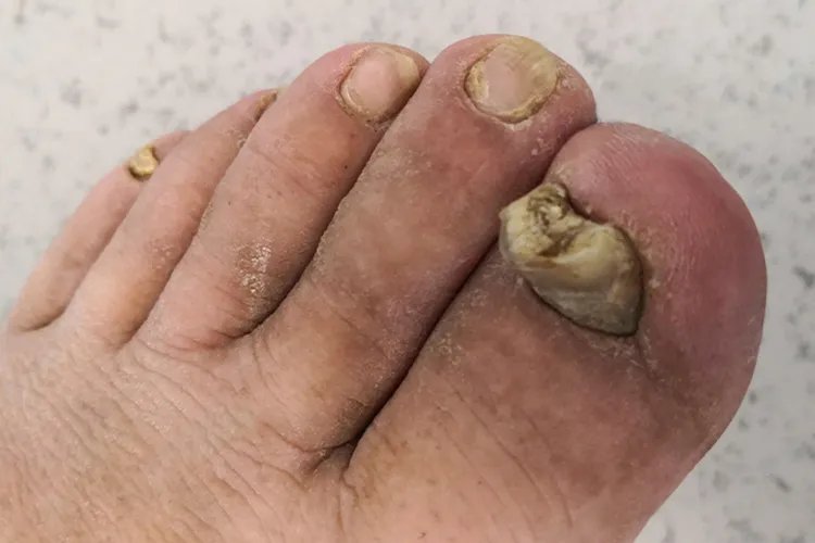 灰指甲图片治疗方法