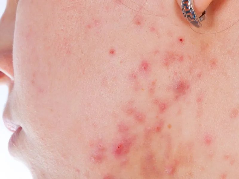 痤疮危害都有哪些