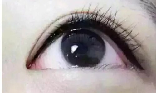 内双割双眼皮怎么样