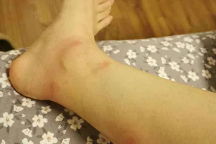 丘疹性荨麻疹脚踝症状图片