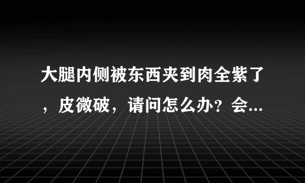 大腿内侧被东西夹到肉全紫了，皮微破，请问怎么办？会...