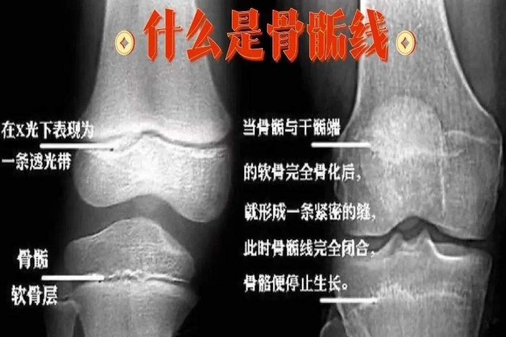 骨骺线在哪个部位图解