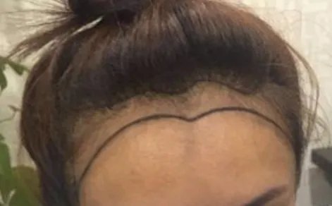 种植发际线要多少钱	