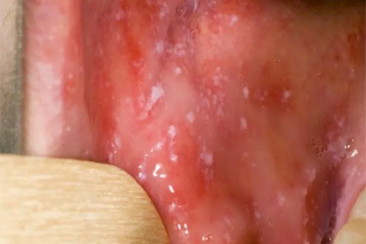 典型麻疹前驱期症状图片