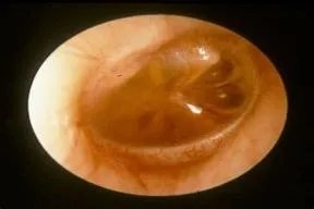 小孩腺样体肥大图片