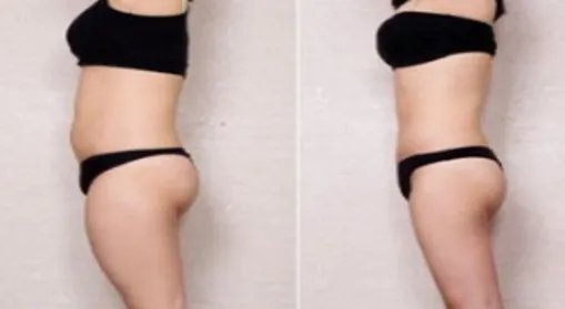 局部抽脂多少钱