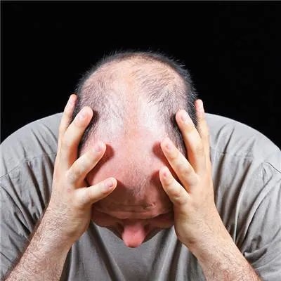 掉头发厉害是什么原因