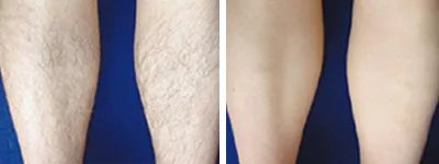 激光脱毛整形多少钱