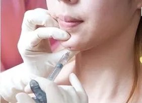 玻尿酸垫下巴的价格