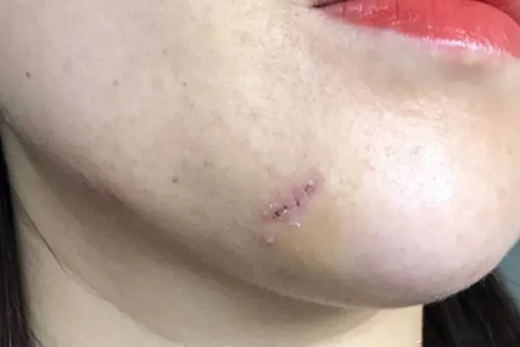 切痣恢复过程图