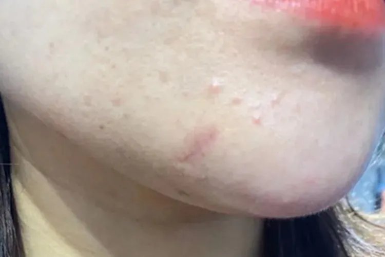 切痣恢复过程图