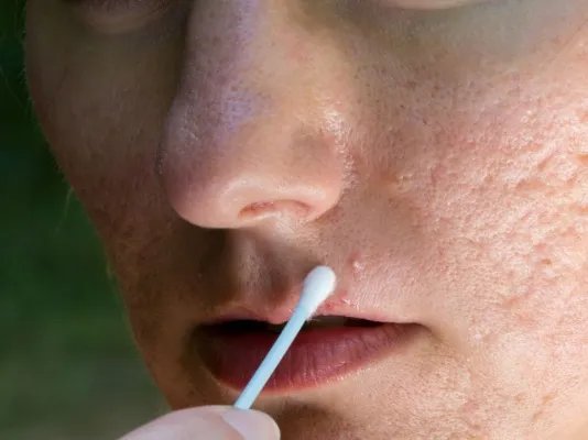 治疗青春痘的常见方法