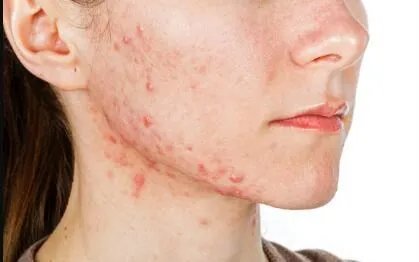 做祛痘需要多少钱？费用是多少？